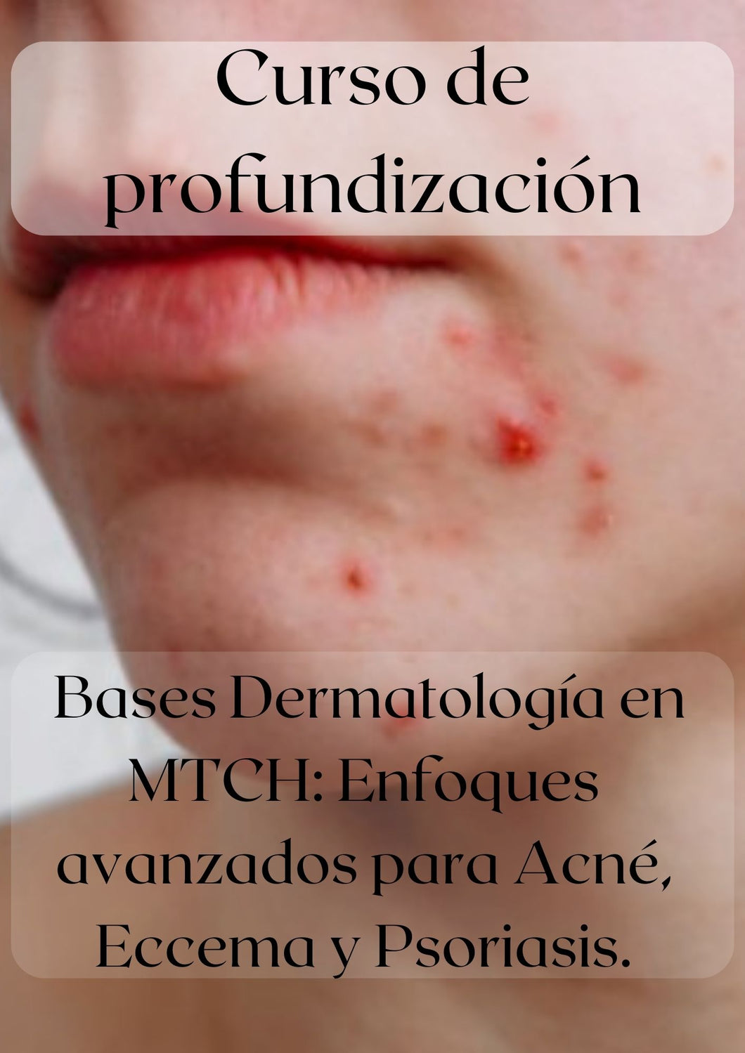 Curso de profundización: Bases Dermatología en MTCH: Enfoques avanzados para Acné, Eccema y Psoriasis.