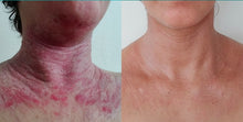 Cargar imagen en el visor de la galería, Curso de profundización: Bases Dermatología en MTCH: Enfoques avanzados para Acné, Eccema y Psoriasis.
